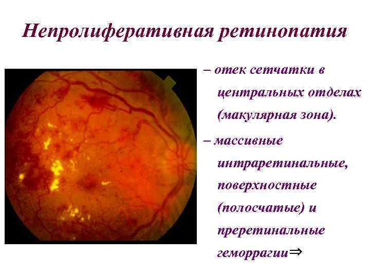 Непролиферативная ретинопатия – отек сетчатки в центральных отделах (макулярная зона). – массивные интраретинальные, поверхностные