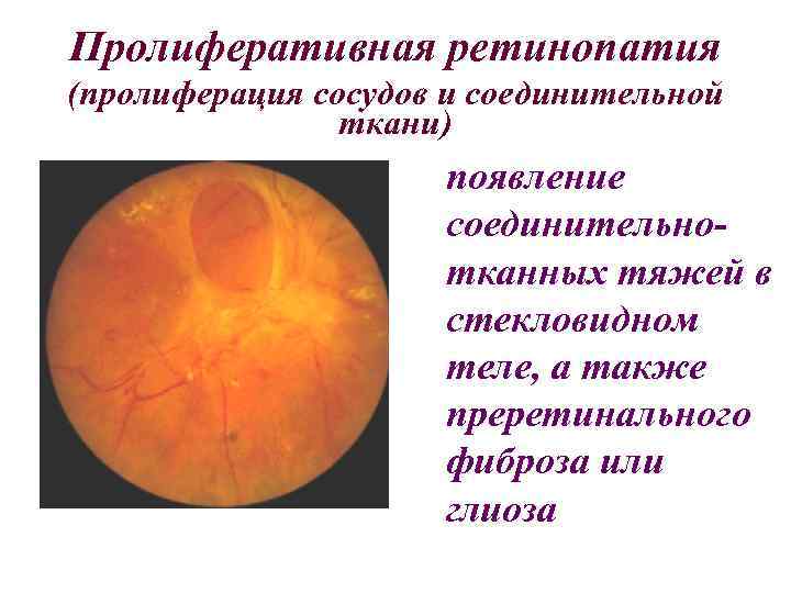 Пролиферативная ретинопатия (пролиферация сосудов и соединительной ткани) появление соединительнотканных тяжей в стекловидном теле, а