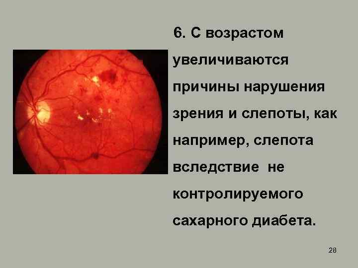  6. С возрастом увеличиваются причины нарушения зрения и слепоты, как например, слепота вследствие