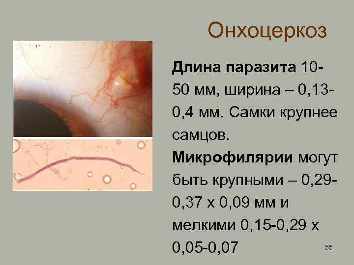 Онхоцеркоз Длина паразита 1050 мм, ширина – 0, 130, 4 мм. Самки крупнее самцов.