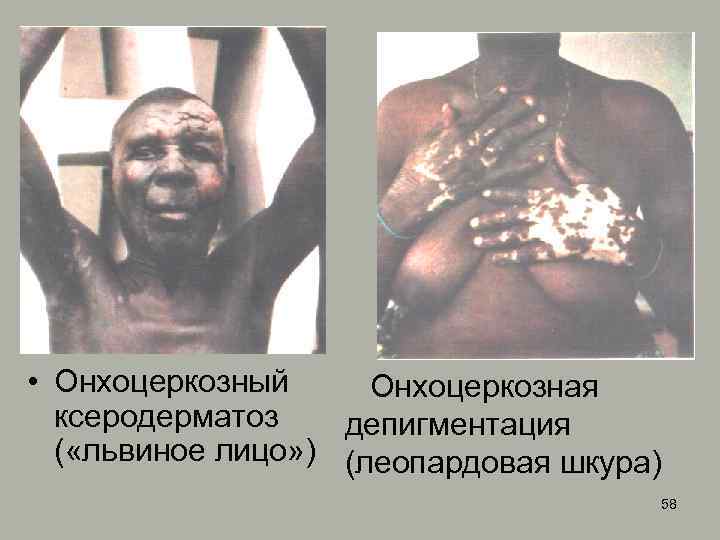  • Онхоцеркозный Онхоцеркозная ксеродерматоз депигментация ( «львиное лицо» ) (леопардовая шкура) 58 