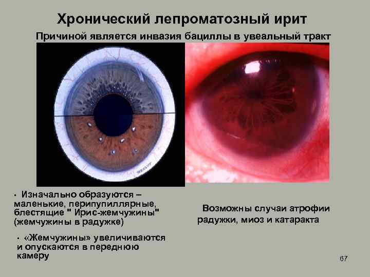 Хронический лепроматозный ирит Причиной является инвазия бациллы в увеальный тракт Изначально образуются – маленькие,