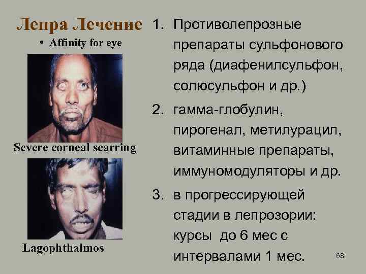 Лепра Лечение • Affinity for eye Severe corneal scarring Lagophthalmos 1. Противолепрозные препараты сульфонового