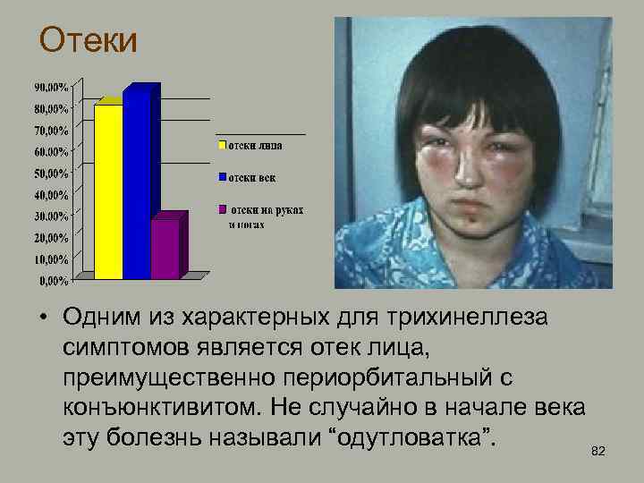 Отеки • Одним из характерных для трихинеллеза симптомов является отек лица, преимущественно периорбитальный с