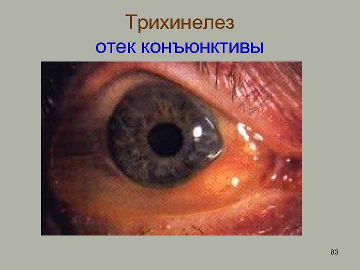 Трихинелез отек конъюнктивы 83 