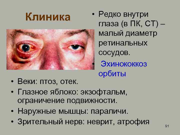 Клиника • Редко внутри глаза (в ПК, СТ) – малый диаметр ретинальных сосудов. •