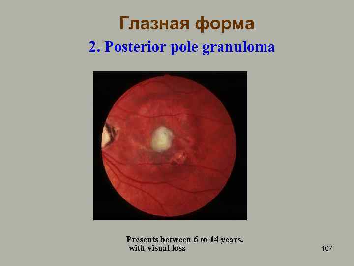 Глазная форма 2. Posterior pole granuloma Presents between 6 to 14 years. with visual