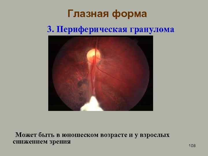 Глазная форма 3. Периферическая гранулома Может быть в юношеском возрасте и у взрослых снижением
