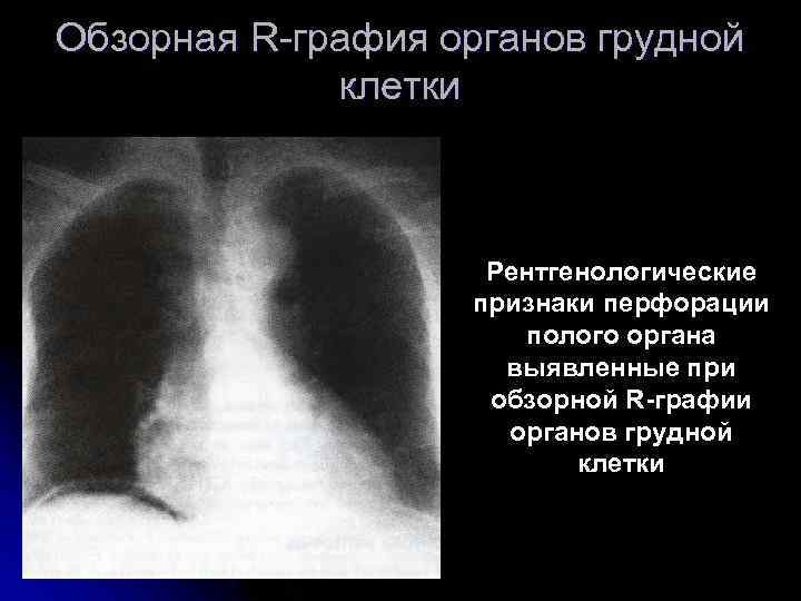 Обзорная R-графия органов грудной клетки Рентгенологические признаки перфорации полого органа выявленные при обзорной R-графии