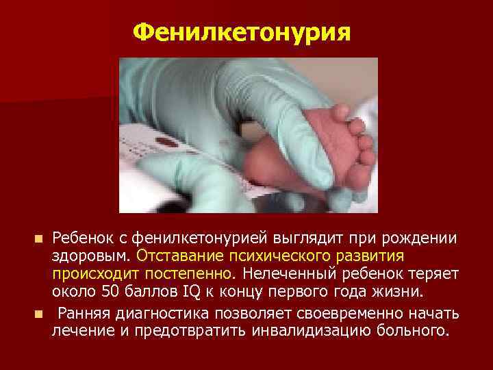 Фенилкетонурия Ребенок с фенилкетонурией выглядит при рождении здоровым. Отставание психического развития происходит постепенно. Нелеченный