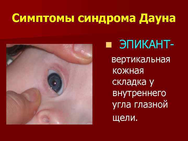 Симптомы синдрома Дауна n ЭПИКАНТвертикальная кожная складка у внутреннего угла глазной щели. 