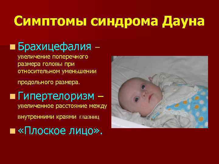 Симптомы синдрома Дауна n Брахицефалия – увеличение поперечного размера головы при относительном уменьшении продольного