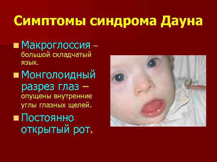 Симптомы синдрома Дауна n Макроглоссия – большой складчатый язык. n Монголоидный разрез глаз –