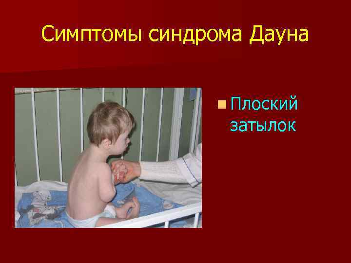 Симптомы синдрома Дауна n Плоский затылок 