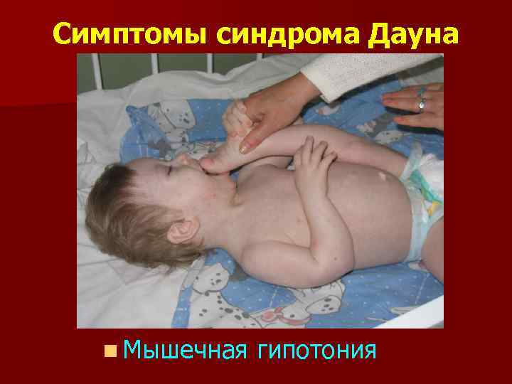 Симптомы синдрома Дауна n Мышечная гипотония 