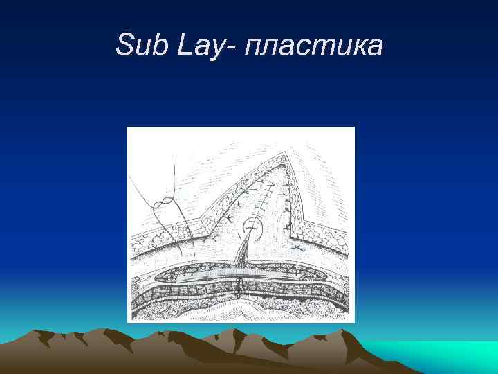 Sub Lay- пластика 