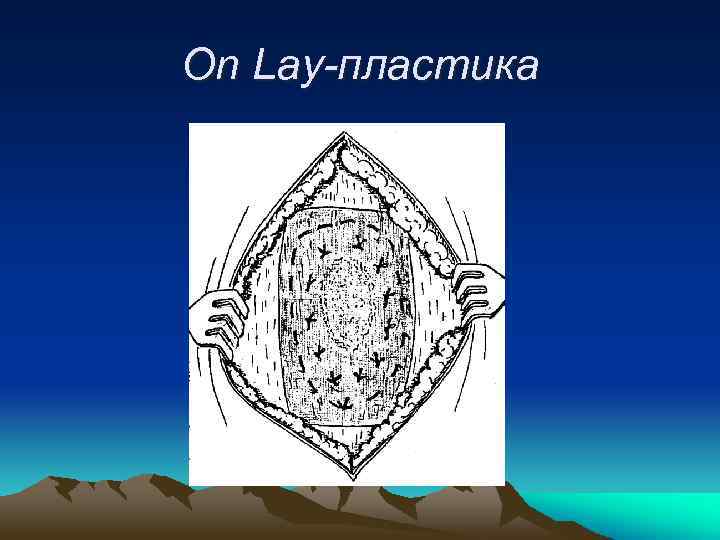 On Lay-пластика 