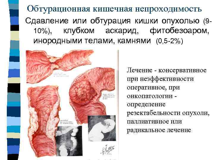 Обтурационная кишечная непроходимость Сдавление или обтурация кишки опухолью (910%), клубком аскарид, фитобезоаром, инородными телами,