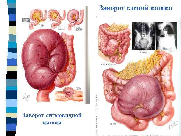 Заворот слепой кишки Заворот сигмовидной кишки 