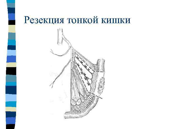 Резекция тонкой кишки 