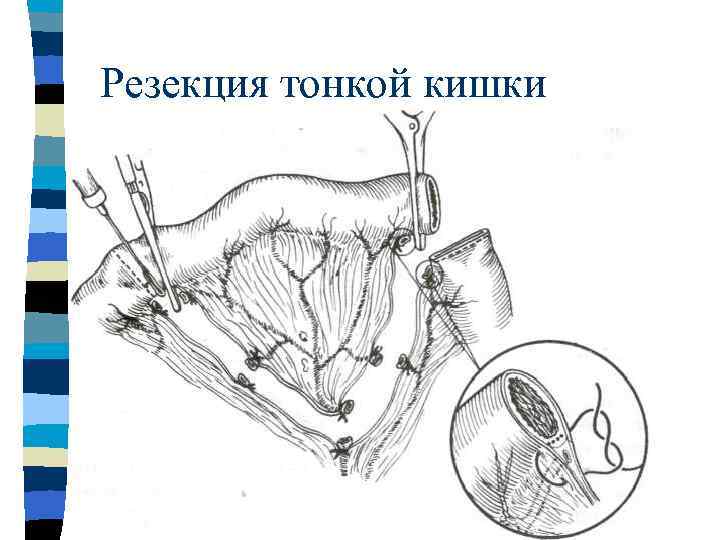 Мобилизация 12 перстной кишки по кохеру схема