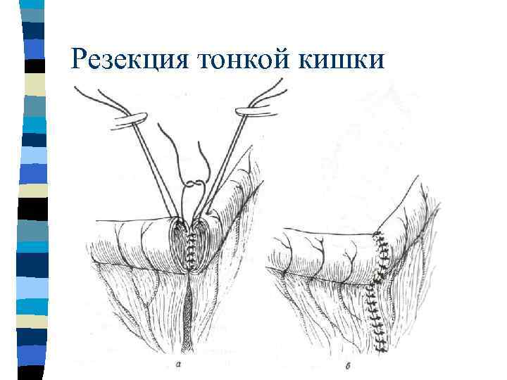 Острая кишечная непроходимость карта вызова скорой медицинской