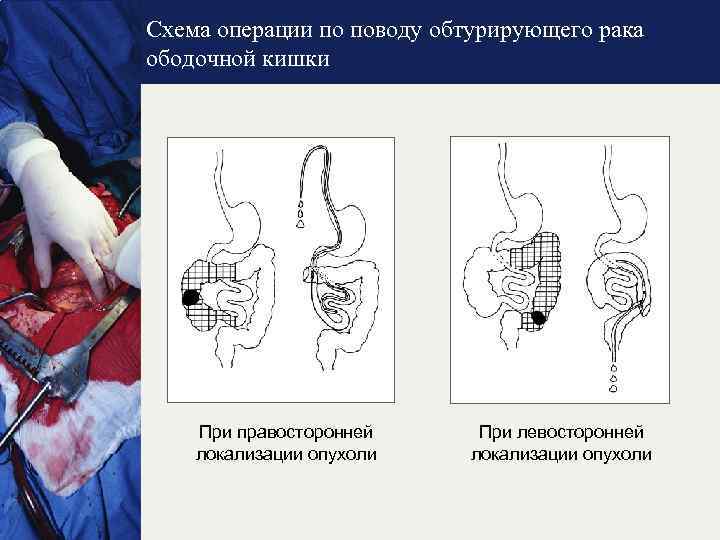 Оки острая кишечная инфекция