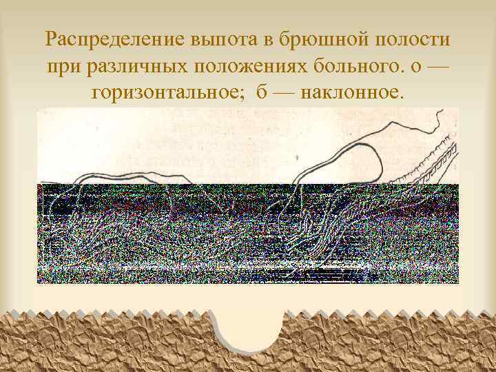 Распределение выпота в брюшной полости при различных положениях больного. о — горизонтальное; б —