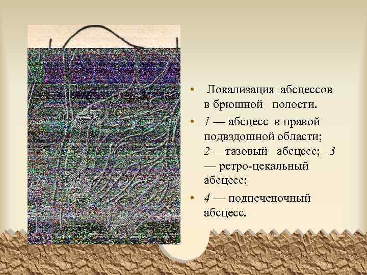  • Локализация абсцессов в брюшной полости. • 1 — абсцесс в правой подвздошной