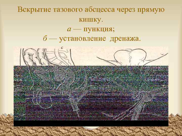 Вскрытие тазового абсцесса через прямую кишку. а — пункция; б — установление дренажа. 