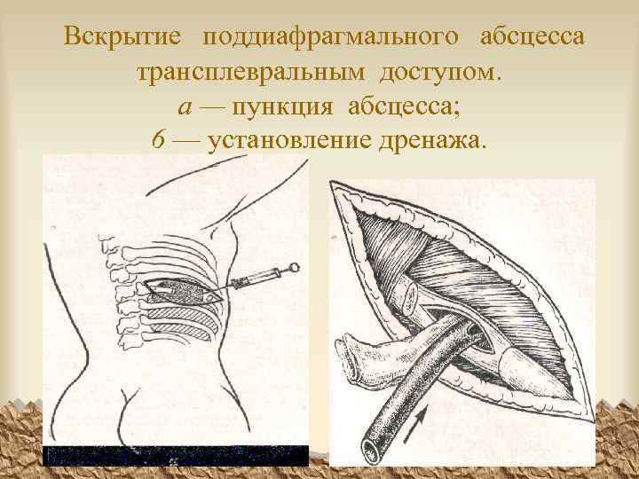 Вскрытие поддиафрагмального абсцесса трансплевральным доступом. а — пункция абсцесса; 6 — установление дренажа. 