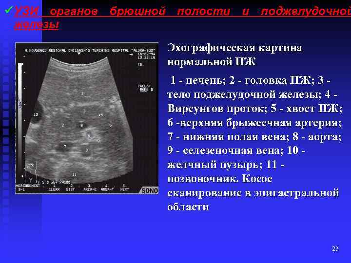 Эхографическая картина нормальной ПЖ 1 - печень; 2 - головка ПЖ; 3 тело поджелудочной