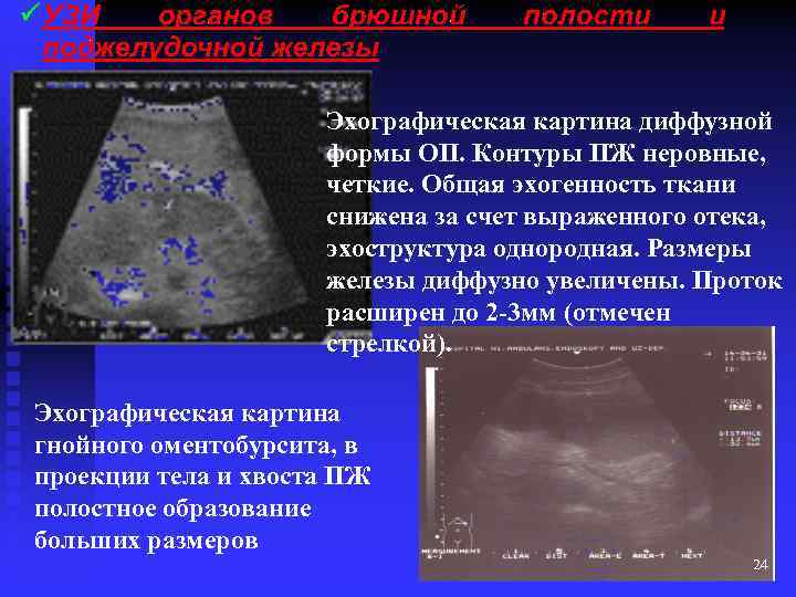 Эхографическая картина диффузной формы ОП. Контуры ПЖ неровные, четкие. Общая эхогенность ткани снижена за