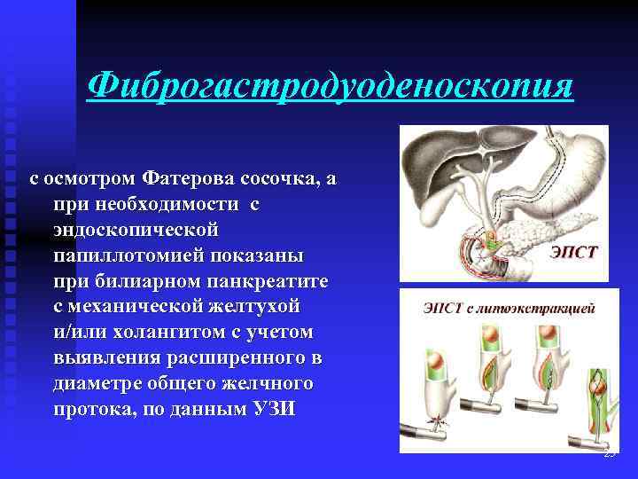 Фиброгастродуоденоскопия с осмотром Фатерова сосочка, а при необходимости с эндоскопической папиллотомией показаны при билиарном