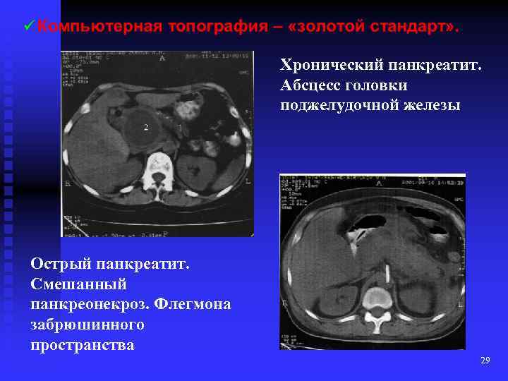 Хронический панкреатит. Абсцесс головки поджелудочной железы Острый панкреатит. Смешанный панкреонекроз. Флегмона забрюшинного пространства 29