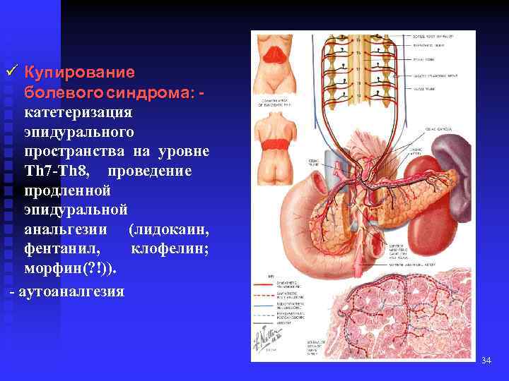 ü Купирование болевого синдрома: катетеризация эпидурального пространства на уровне Th 7 -Th 8, проведение