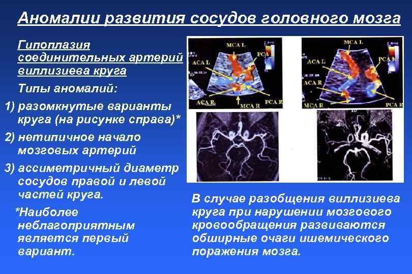 Гипоплазия правой артерии мозга. Аномалии сосудов головного мозга. Аномалии развития сосудов головного мозга. Аномалии развития артерий головного мозга. Порок сосудов головного мозга что это такое.