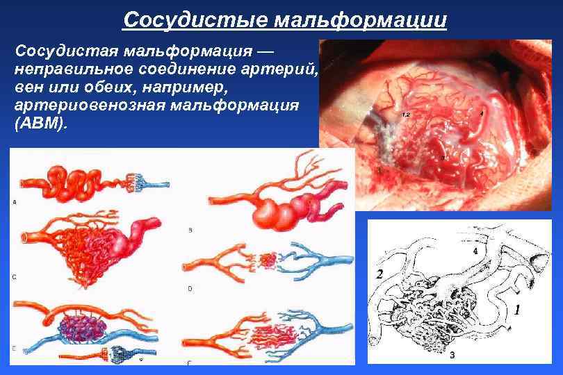 Сосудистые мальформации Сосудистая мальформация — неправильное соединение артерий, вен или обеих, например, артериовенозная мальформация