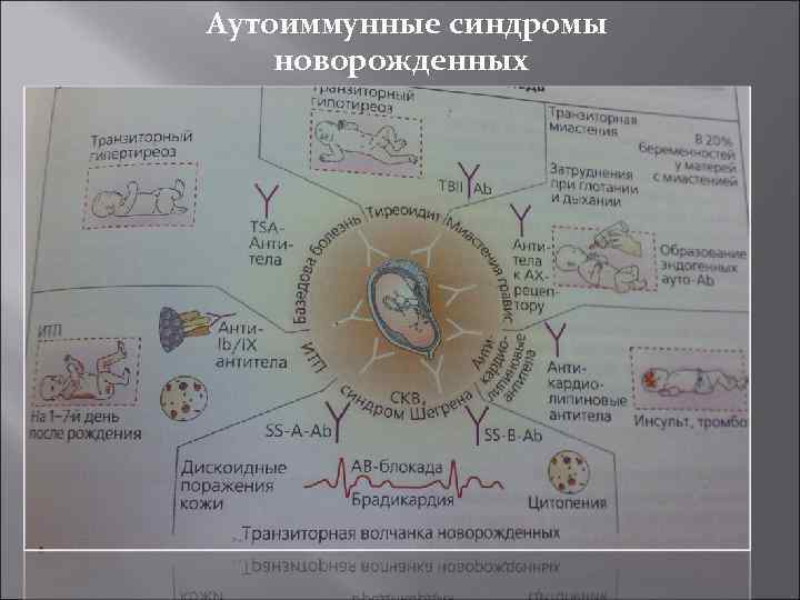 Аутоиммунные синдромы новорожденных 