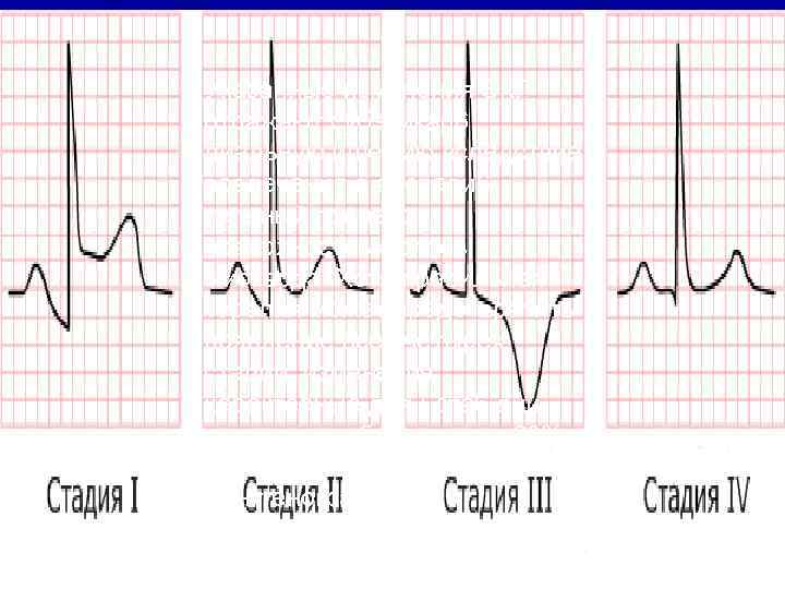 Указанные изменения ЭКГ отражают субэпикар6 диальную ишемию вследствие вовлечения в воспали 6 тельный процесс