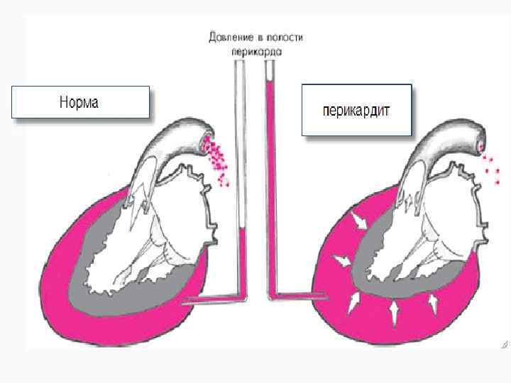 Гнойный перикардит фото