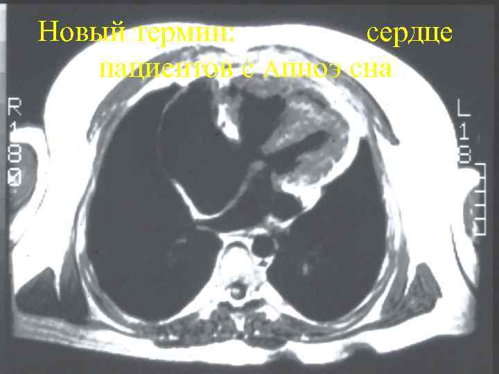 Новый термин: сердце пaциeнтов c Апноэ сна 