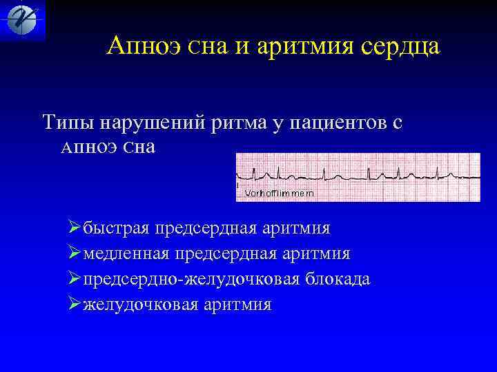  Апноэ Сна и аритмия сердца Типы нарушений ритма у пациентов с Апноэ Сна