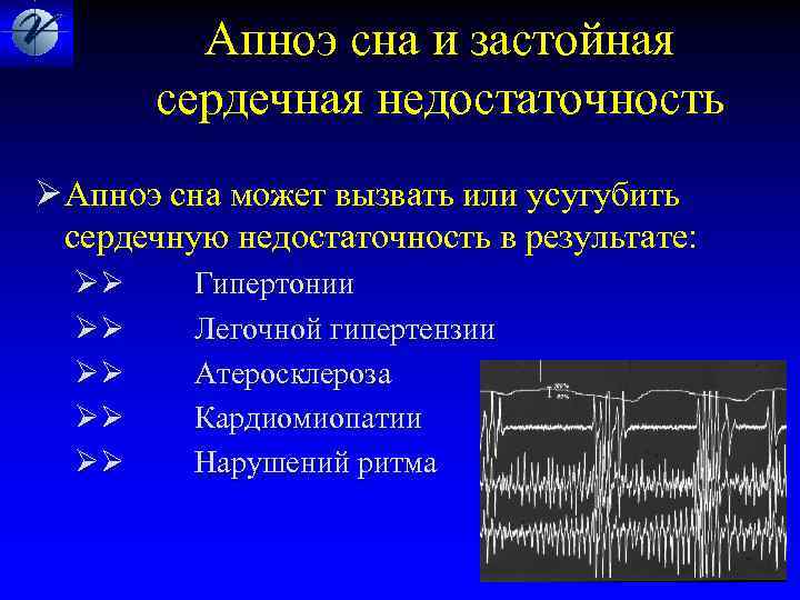  Апноэ сна и застойная сердечная недостаточность Ø Апноэ сна может вызвать или усугубить