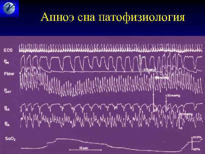 Апноэ сна Патофизиология 