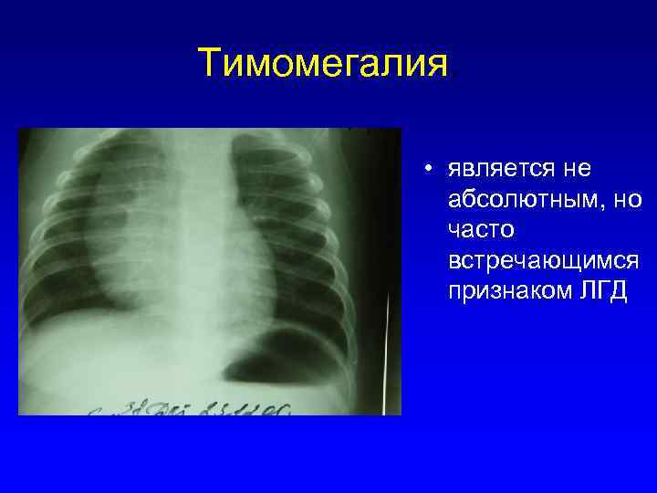 Тимомегалия. • является не абсолютным, но часто встречающимся признаком ЛГД 