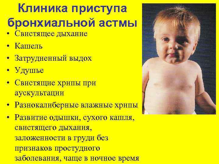 Клиника приступа бронхиальной астмы • • • Свистящее дыхание Кашель Затрудненный выдох Удушье Свистящие