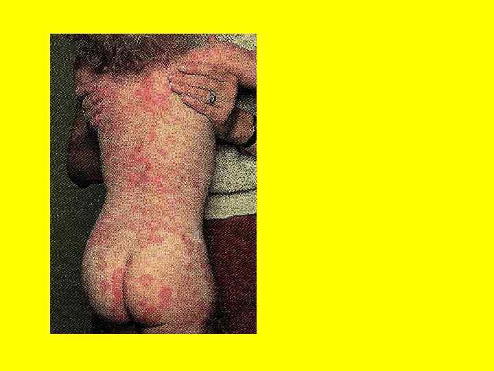 Многоформная эксудативная эритема 