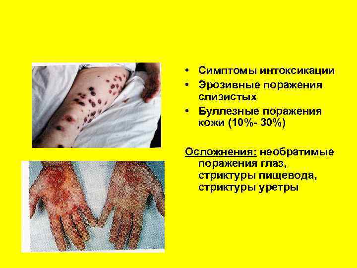 Синдром Стивенса-Джонсона клиника • Симптомы интоксикации • Эрозивные поражения слизистых • Буллезные поражения кожи