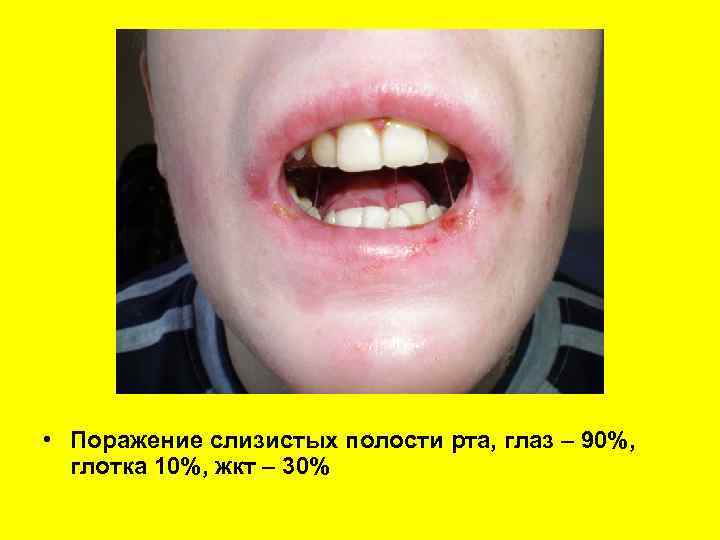  • Поражение слизистых полости рта, глаз – 90%, глотка 10%, жкт – 30%